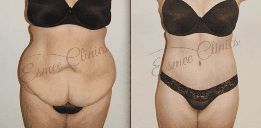 Before and After img